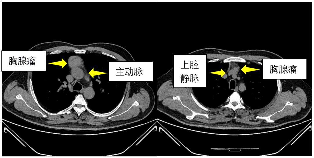 唐都医院纵隔肿瘤开胸手术,西安唐都胸外科手术