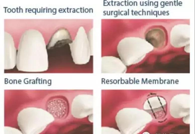 拔完牙窟窿里有食物残渣,拔完牙的窟窿进食物了怎么办