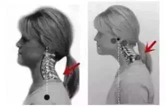 脊柱弯了怎么纠正视频,脊柱侧弯属于严重脊柱问题