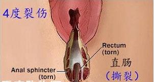 顺产什么情况会被侧切,顺产时候啥情况会引起大出血