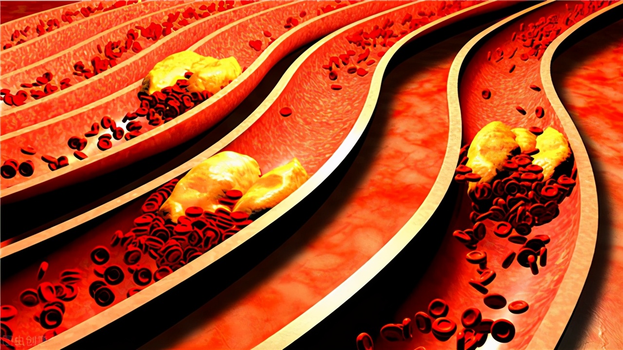 高血压怎么引发的脑梗,高血压引起的脑梗塞有治愈的吗