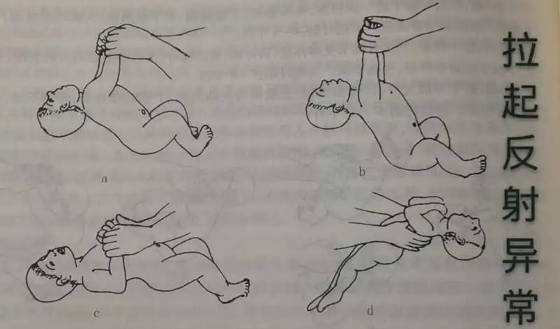 脑瘫儿童的七种异常姿势,判断宝宝脑瘫最简单的方法
