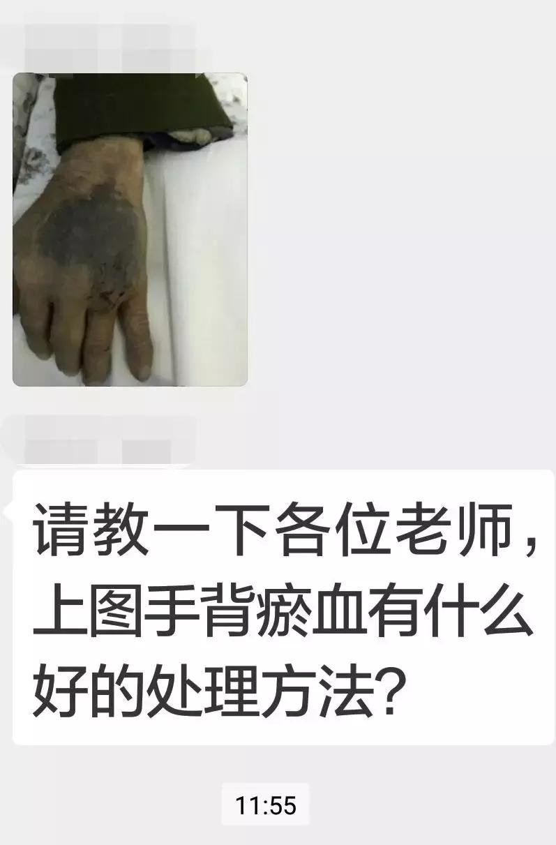 输液手背浮肿怎么消除,手背扎针输液为何手腕瘀血