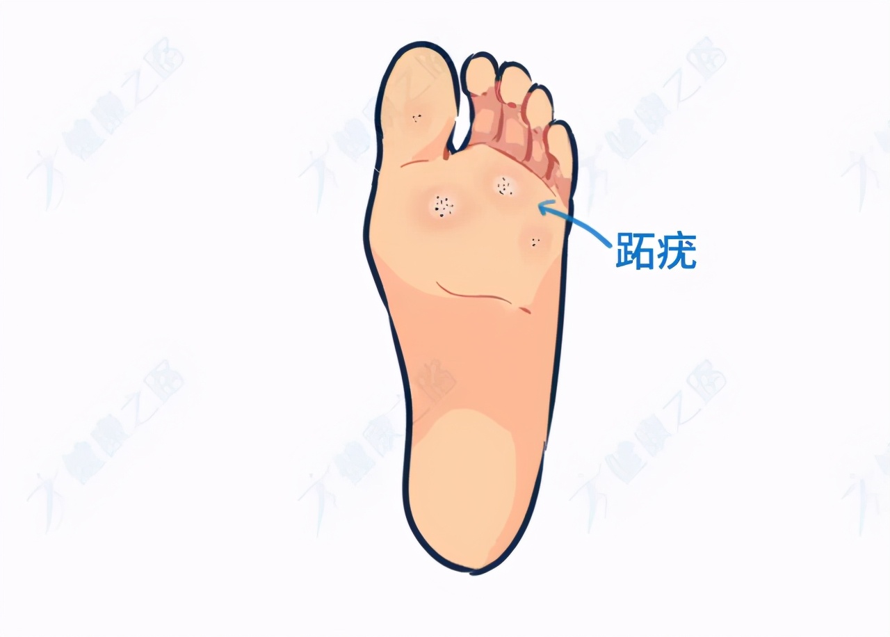 脚底长了鸡眼该怎么正确处理,脚底长鸡眼太深怎么挖出来