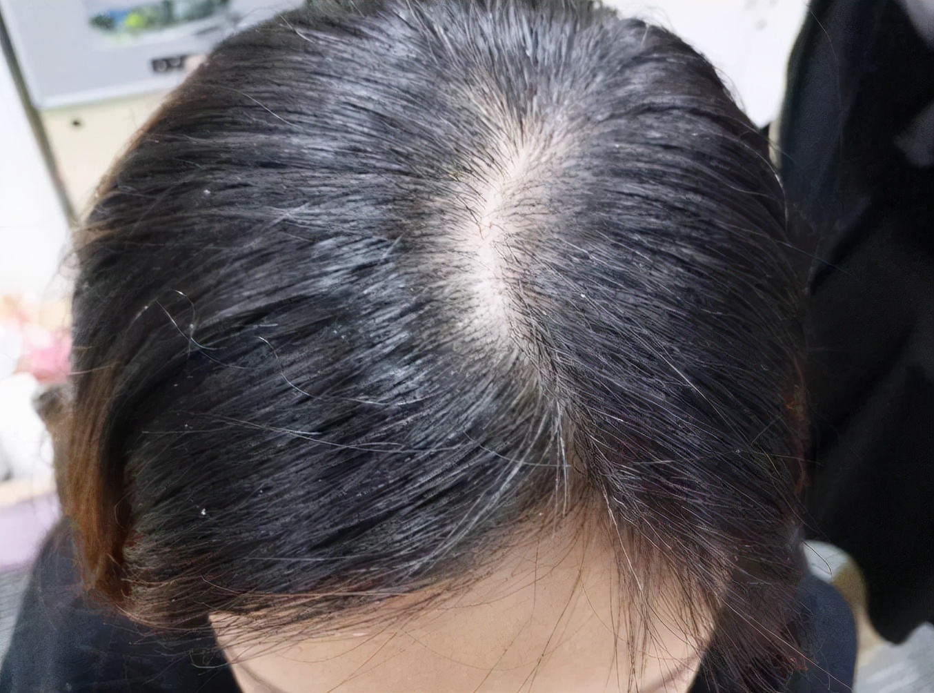 头皮长小疙瘩抠破有脓怎么办,头皮长了个疙瘩破了怎么办