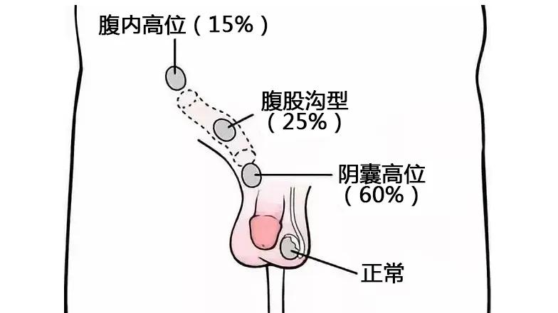 隐睾的宝宝如何日常护理,宝宝先天性隐睾怎么判断