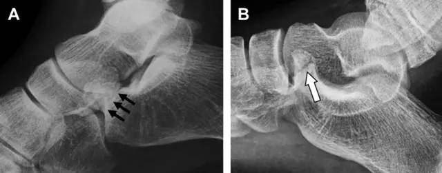 常见的八种骨折,容易漏诊的肩关节骨折
