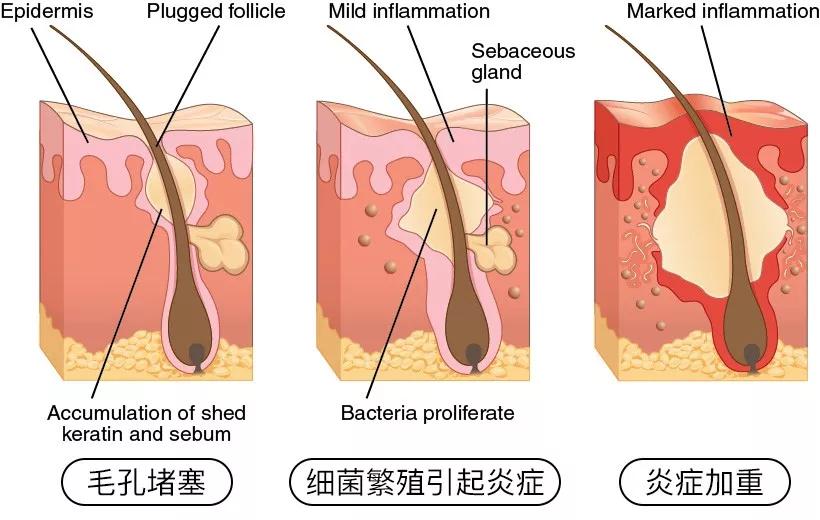 怎样才是消灭痘痘的正确打开方式,痘痘到底要怎么才能消除