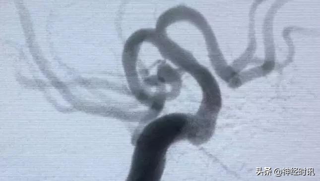 脑血管病介入治疗的介绍,缺血性脑血管病介入治疗进展2015