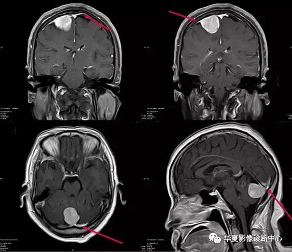 颅脑核磁影像解剖图谱,颅脑mr增强影像图片