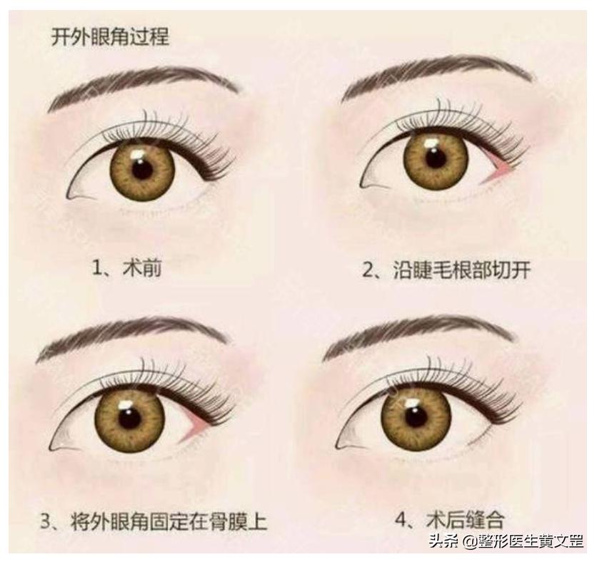 大小眼双眼皮能做眼综合手术吗,眼综合双眼皮全切