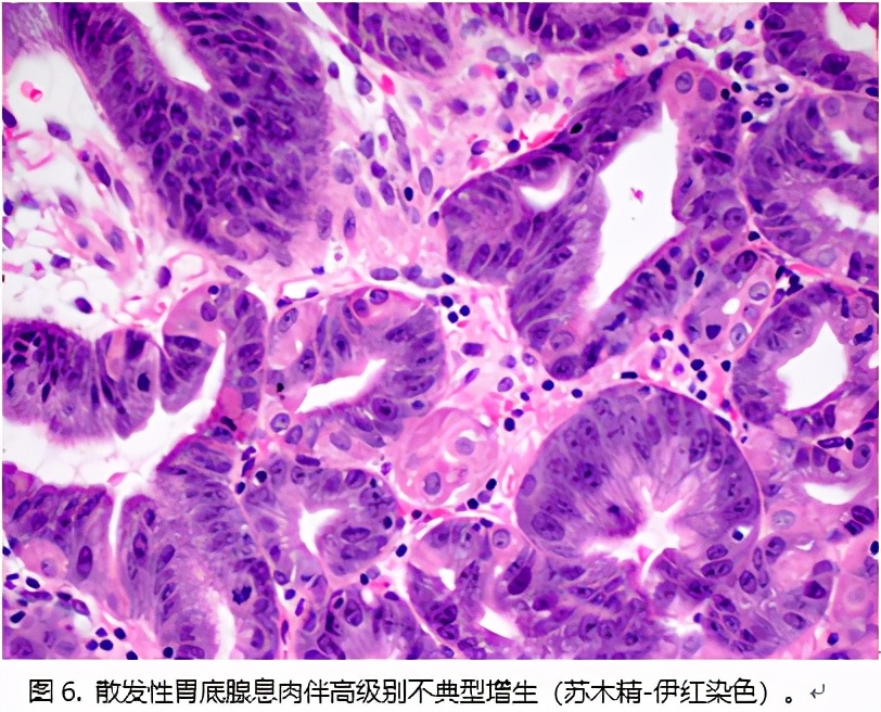 胃息肉可怕不,做胃镜查出胃里有息肉怎么办
