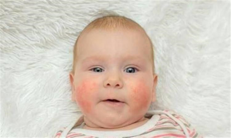 秋冬季节小儿湿疹怎么办,季节性湿疹注意什么