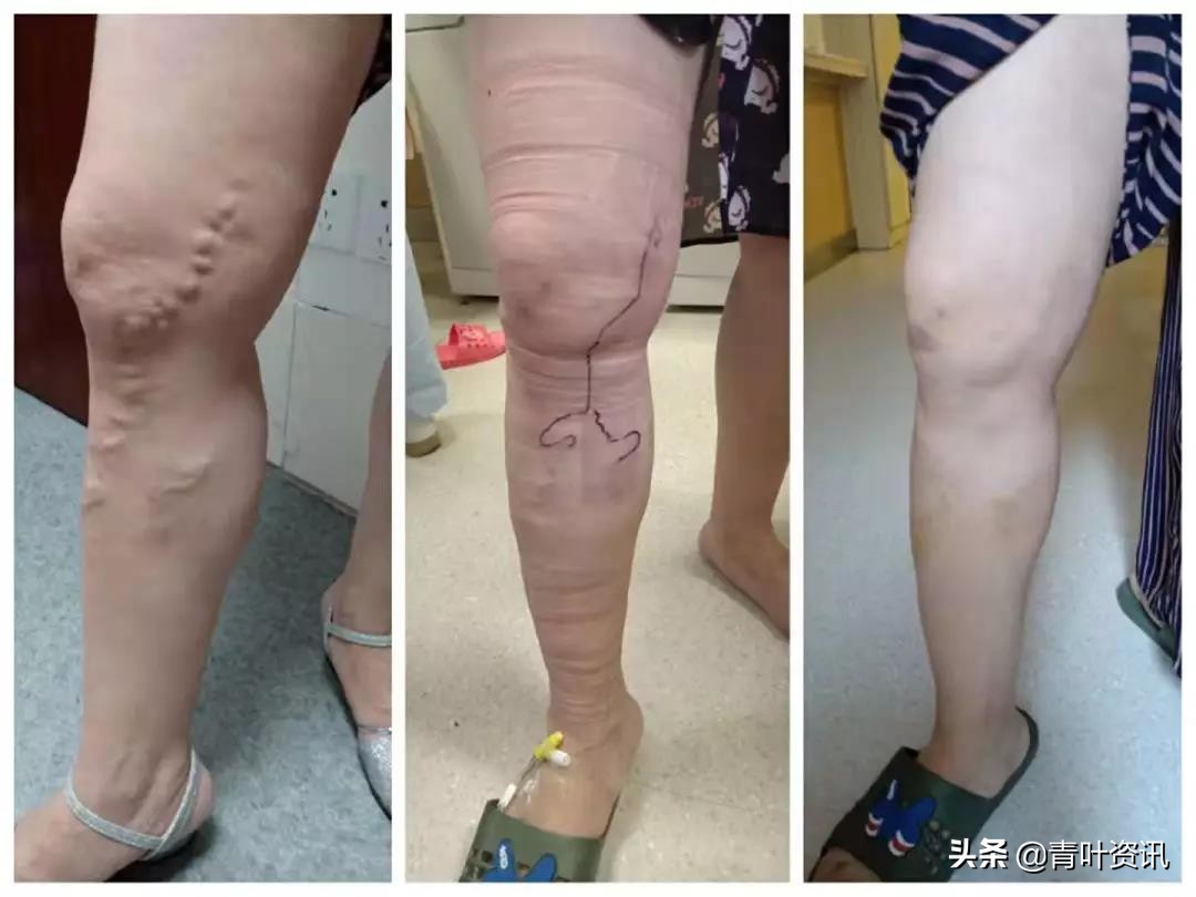 蚯蚓腿微创手术多少钱,蚯蚓腿手术费用多少