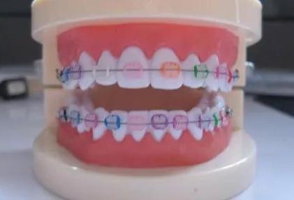 戴牙套遇到最大的牙齿问题,戴牙套必须要知道的事