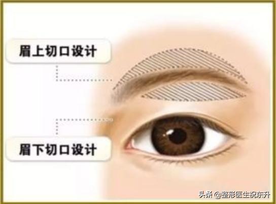 三角眼提眉有后遗症吗,三角眼提眉松弛怎么治