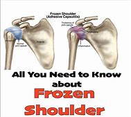 落枕揭秘,落枕医学解释