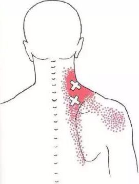 脖子疼用不上劲怎么回事,脖子痛得不能动怎么回事