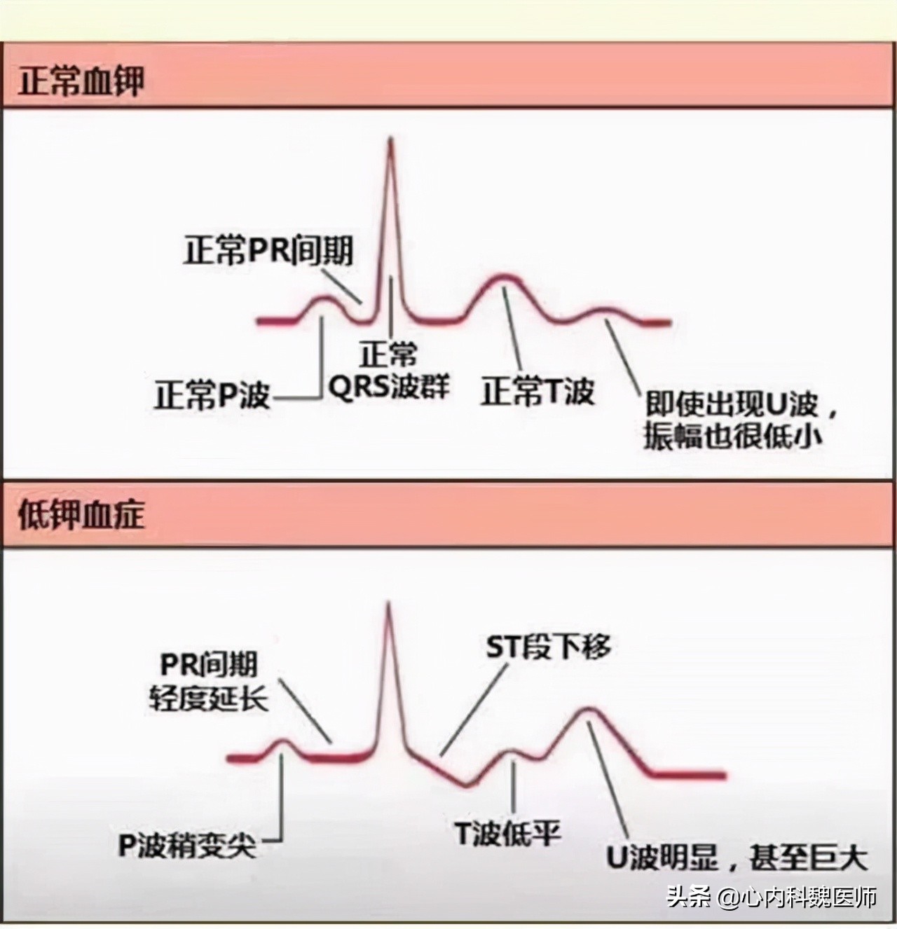 吃降压药引起缺钾会出现什么症状,吃降压药可能导致缺钾