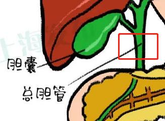 一招解决胆结石的方法,胆结石最快止疼方法穴位