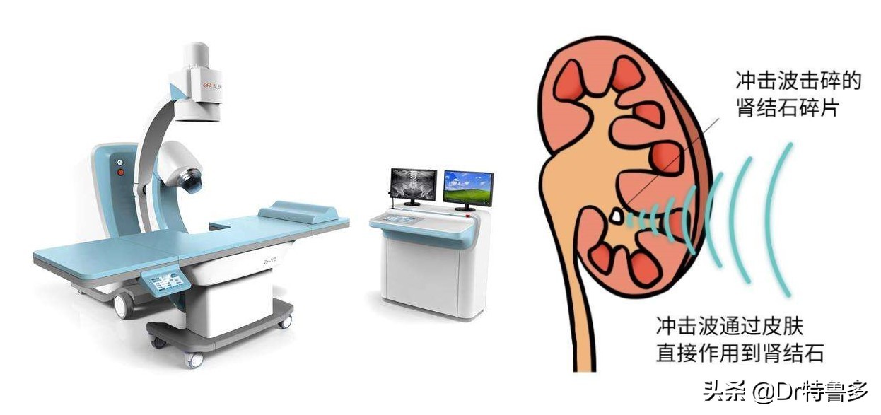 骨折了不长、长得慢怎么办?试试冲击波治疗吧