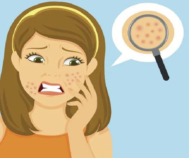 困扰了十几年的痘坑提上日程,困扰了十几年的痘坑