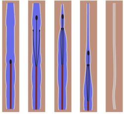 下肢静脉曲张,不怕,医生说可防!可治