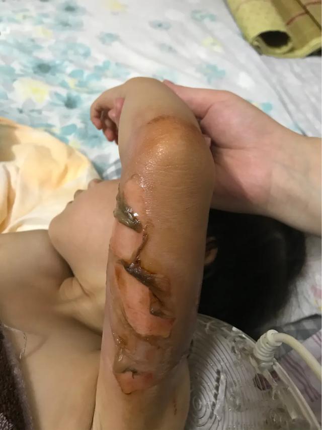 当女儿被严重烫伤疼痛难忍,幼儿园女孩被烫伤治疗过程