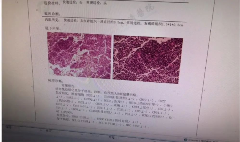 确诊淋巴瘤的最可靠依据是什么,淋巴瘤预后差有治疗必要吗