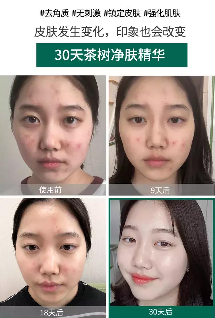 茶树somebymi爽肤水的使用方法,somebymi茶树精华