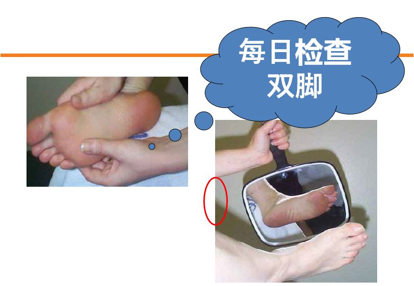 糖尿病28岁医生,29岁糖尿病肾病三期能治好吗