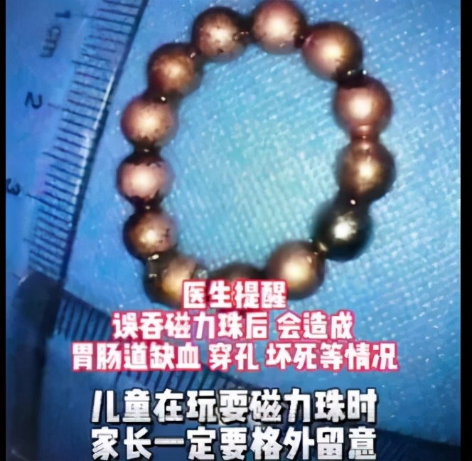 男童误吞123颗磁力珠,三岁男童误吞八颗磁力珠