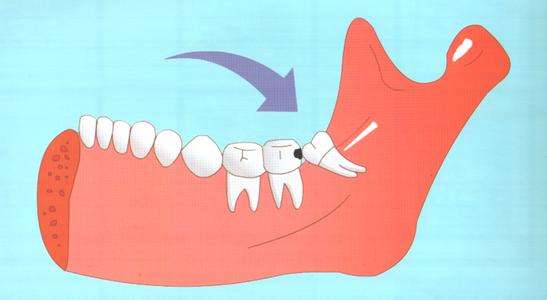 阻生智齿要趁早拔吗,阻生智齿非拔不可吗