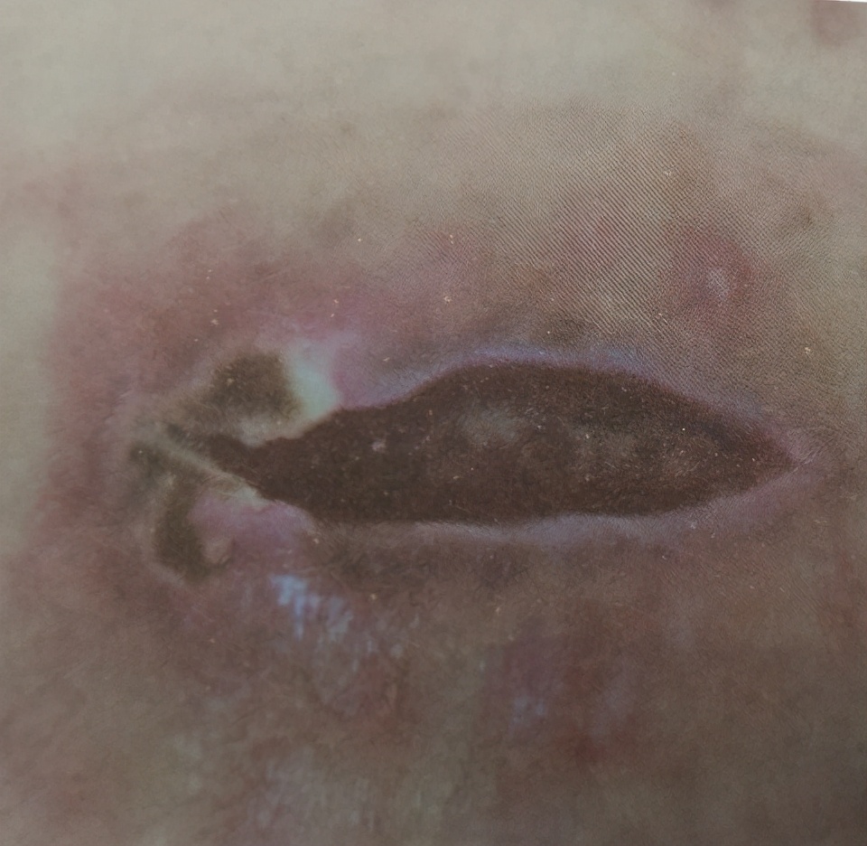 腹部切口感染正确处理方法,切口感染的原因有哪些