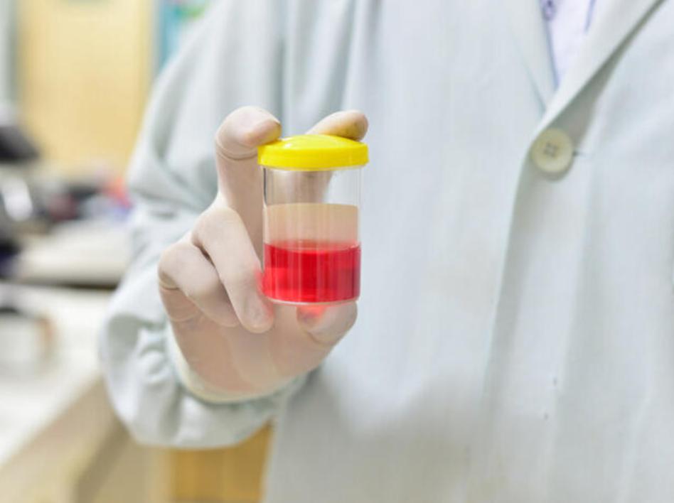 发现小便颜色不对,尿尿颜色不对查什么科