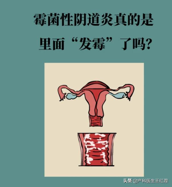 白带增多、脓性灰黄色伴豆渣样、霉菌性阴道炎真的是“发霉”了吗