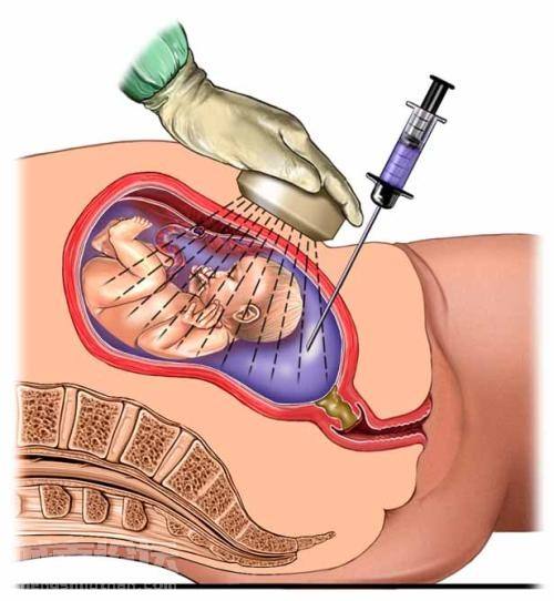 有多少人做羊水穿刺,羊水穿刺要看真实年龄孕周吗
