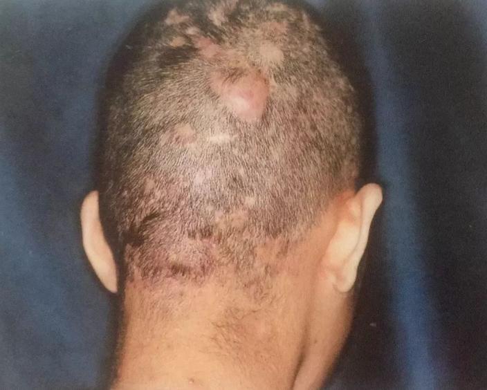 头皮长疙瘩和脓包怎么回事,为什么头皮会长疙瘩和脓包