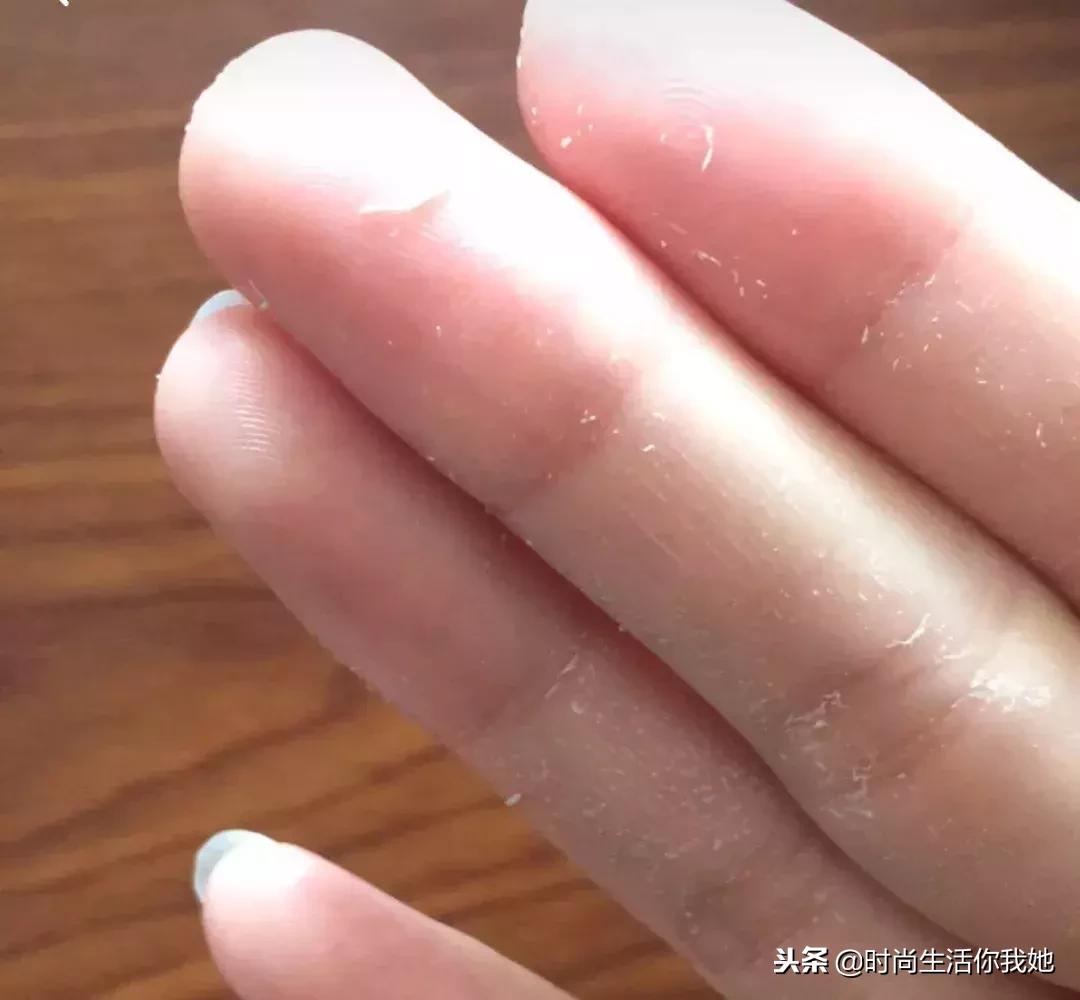 干皮爱出油是什么皮肤,脸上出油而且好多死皮