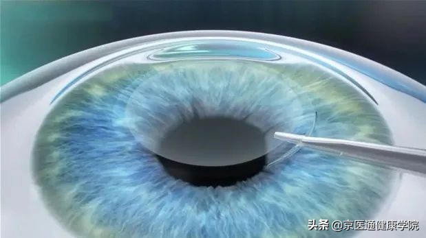 近视手术哪种手术对眼睛伤害小,激光近视手术好还是晶体手术好