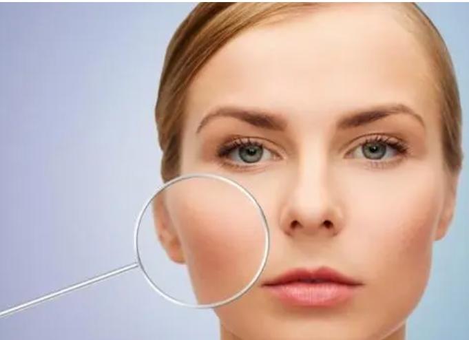 敏感肌红血丝易泛红怎么消除,敏感肌红血丝在护肤时应注意什么