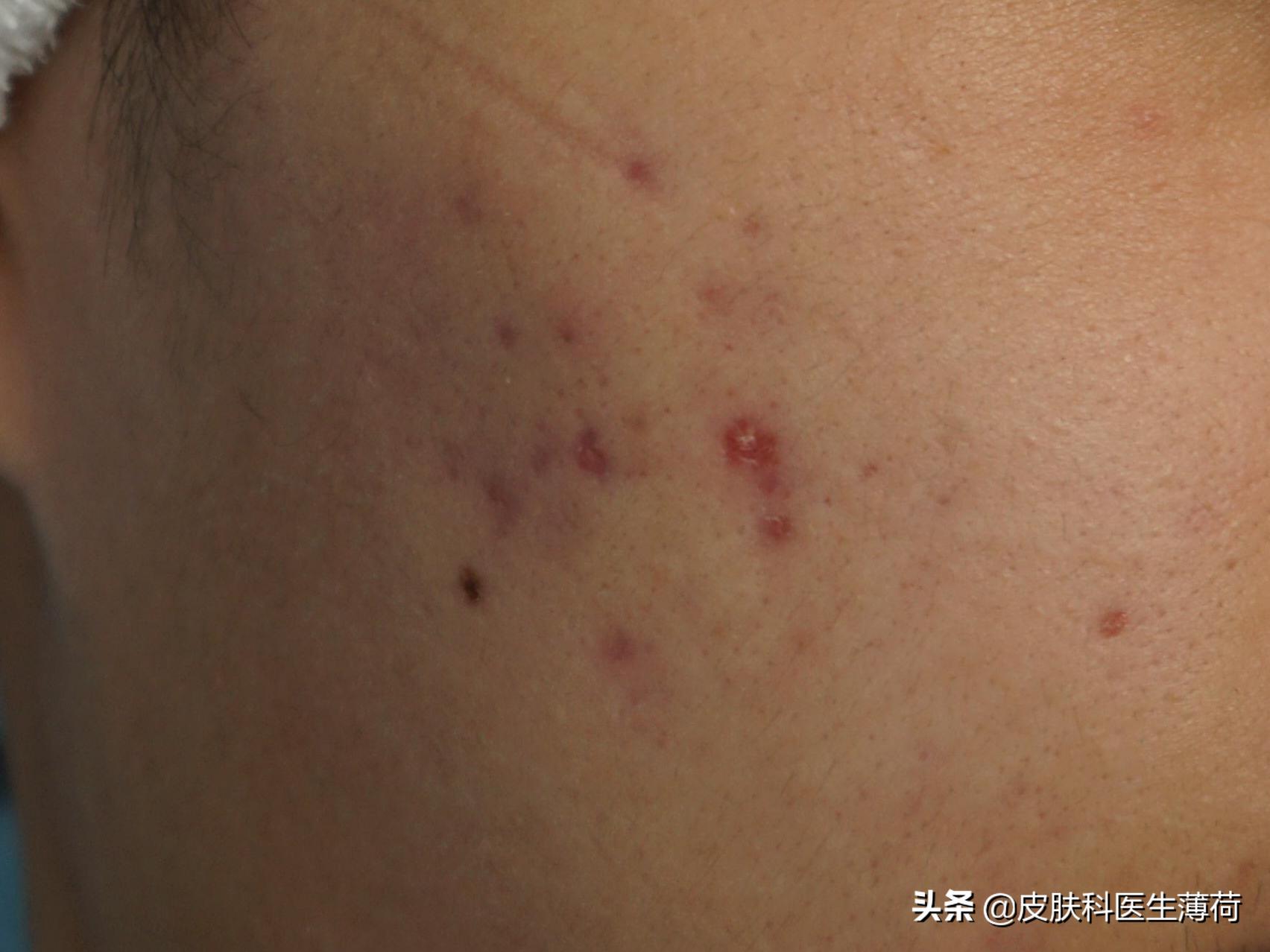皮肤科医生教你如何处理痘印,医院的皮肤科主治痘痘痘印吗