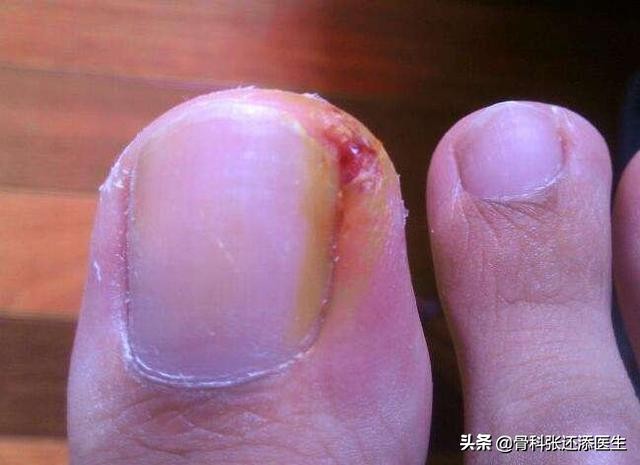 岳云鹏修脚,岳云鹏甲沟炎