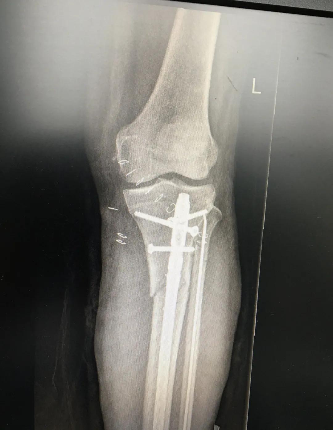 小腿挤压大量淤血能在家自愈吗,小腿碎成三截还能复原吗