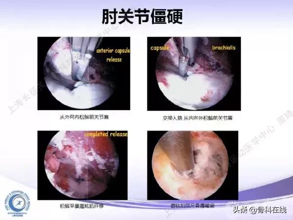 肘关节镜手术后引流,肘关节镜微创手术
