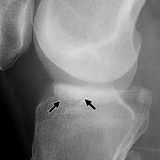 骨折处出现麻痹感,骨折跟精神状态有关