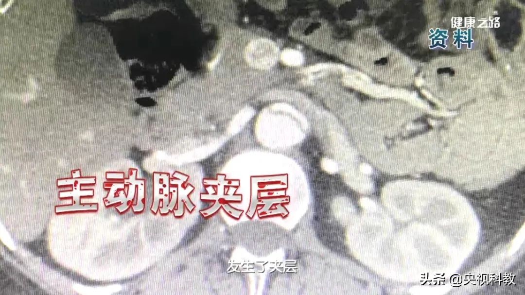 血管主动脉夹层能活多久,警惕凶险的主动脉夹层你了解多少