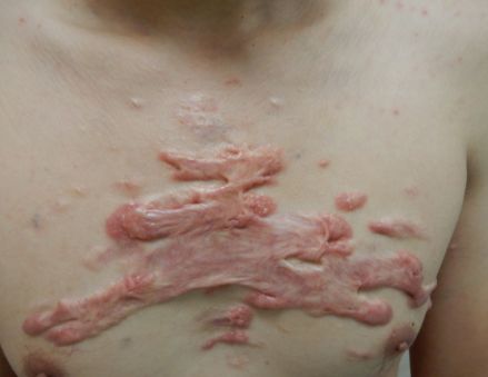 疤痕增生刺痛怎么缓解,为什么按疤痕会有刺痛