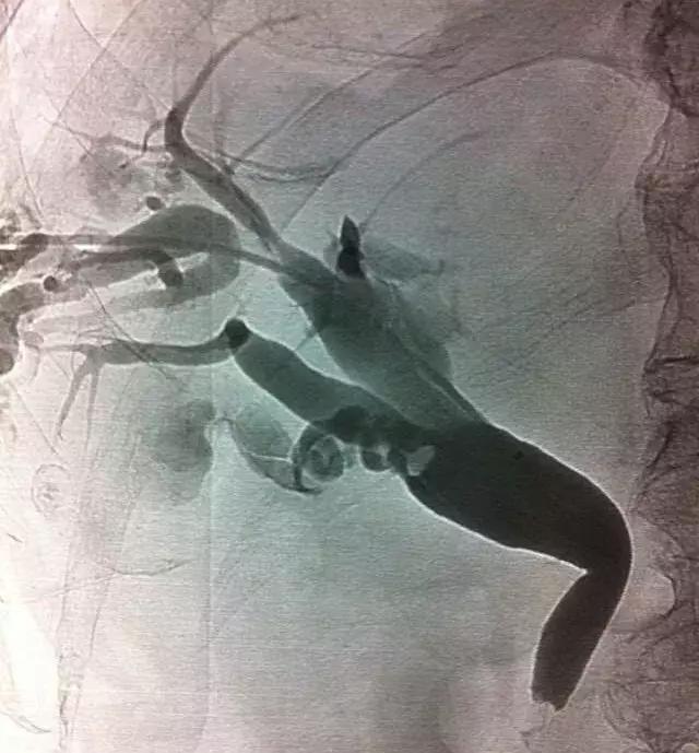 急性胆管炎会不会传染黄疸,胆囊炎和胆管炎会出现黄疸嘛