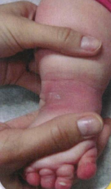 马蹄足畸形矫正案例,足踝部畸形矫正